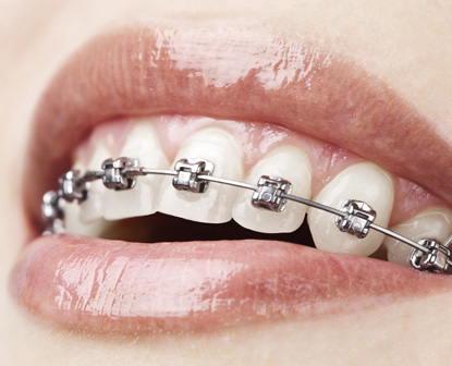 appareils orthodontiques